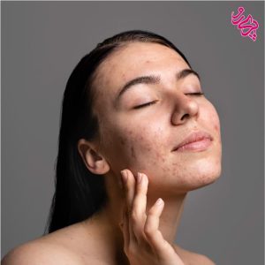 پوست چرب و جوش دار پوست چرب، جوش دار و آکنه ای | پریرو